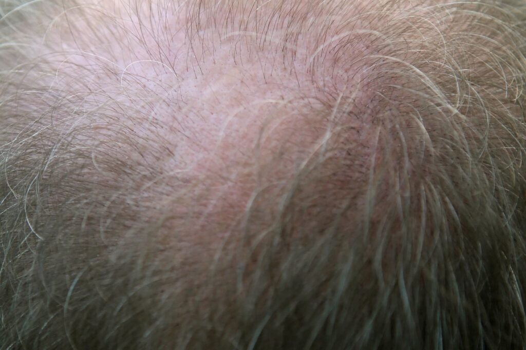 Man facing Hair Fall
